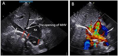 Case Report: Three-Dimensional Printing–Assisted Surgical Treatment of Complex Body Vein Ectopic Drainage